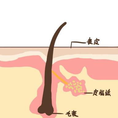 不懂就问，脸上毛孔粗大有黑头粉刺怎么办？
