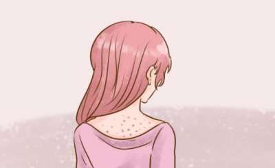 你了解如何治疗马拉色菌引起的皮肤病吗？这个方法必须收藏！