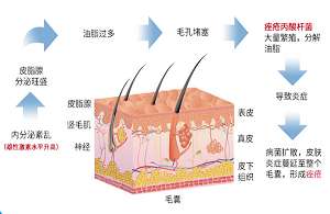 合理用药：痤疮外用药用在什么部位