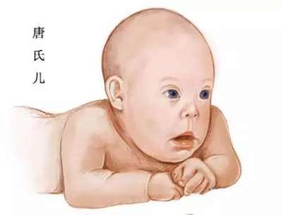 了解“唐宝宝”，预防最重要!