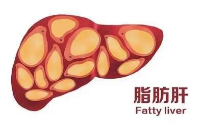 查出脂肪肝 别不当回事