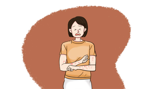 被跳蚤咬后涂什么药膏