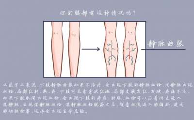 下肢静脉曲张是什么原因引起的