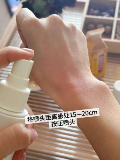 手腕扭伤肿胀用什么药好